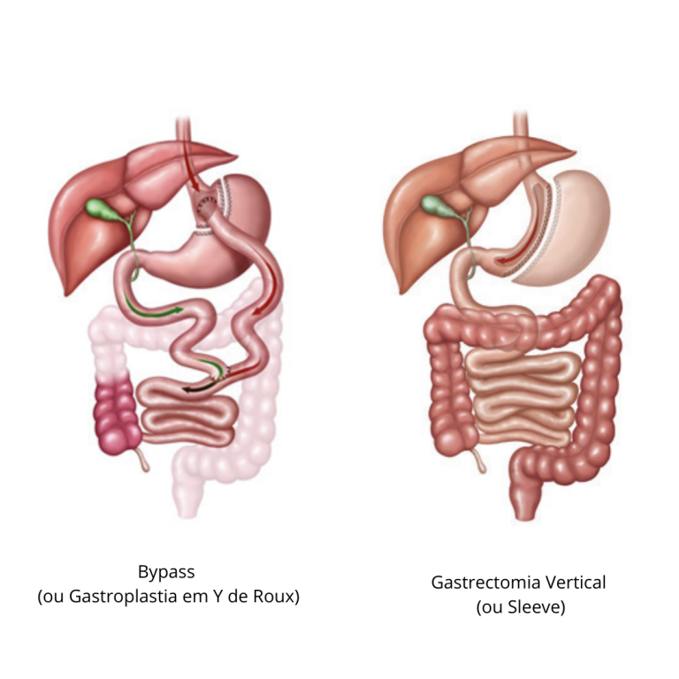 Bypass e Sleeve, quais as diferenças? Blog Clinica Concon