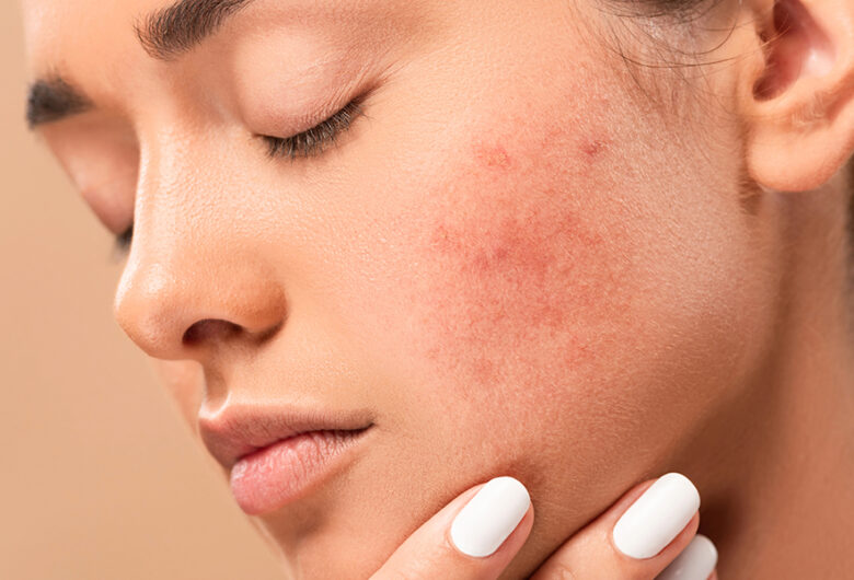 Manchas na pele: como identificar sinais de alerta e quando procurar um dermatologista